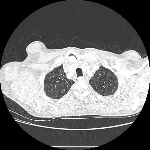 Bronchocele (Radiopaedia 17097-16795 Axial lung window 19).jpg