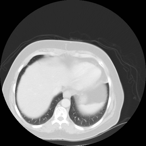 Bronchogenic carcinoma (Radiopaedia 73497-84262 Axial lung window 50).jpg