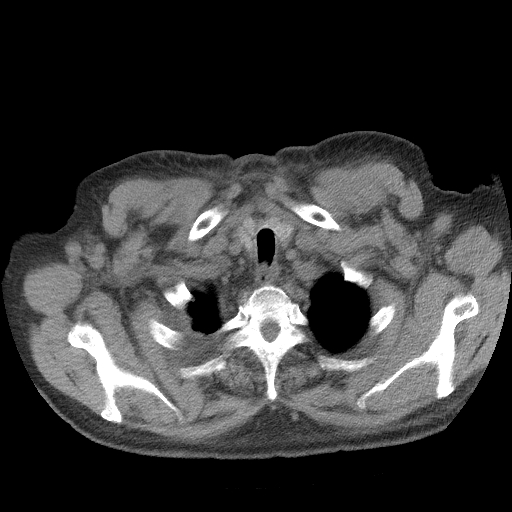 Bronchogenic carcinoma with metastatic lymphadenopathy (Radiopaedia 37671-39569 Axial non-contrast 6).jpg
