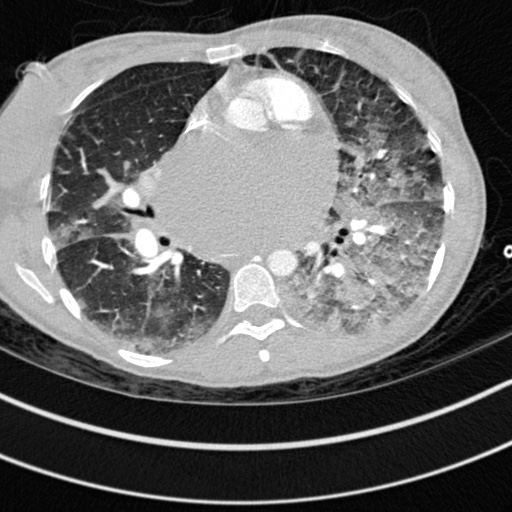 Bronchogenic cyst (Radiopaedia 77801-90071 Axial lung window 40).jpg