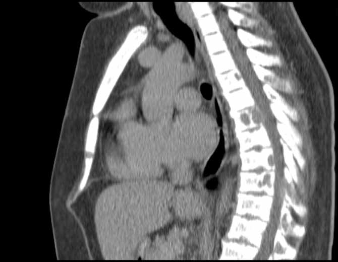 Brown tumors compressing the spinal cord (Radiopaedia 68442-77988 B 31).jpg