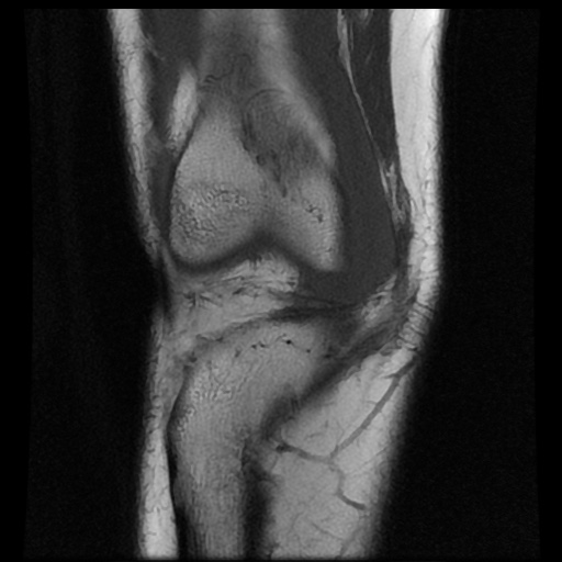 File:Bucket handle meniscus tear (Radiopaedia 56916-63751 Coronal T1 6).jpg