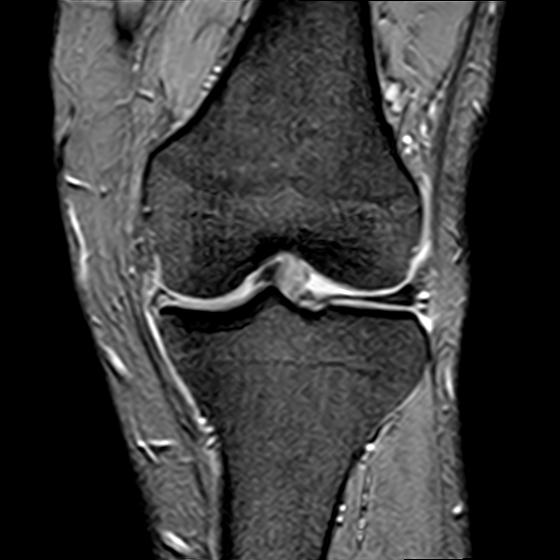 File:Bucket handle tear - medial meniscus (Radiopaedia 29250-29664 B 9).jpg