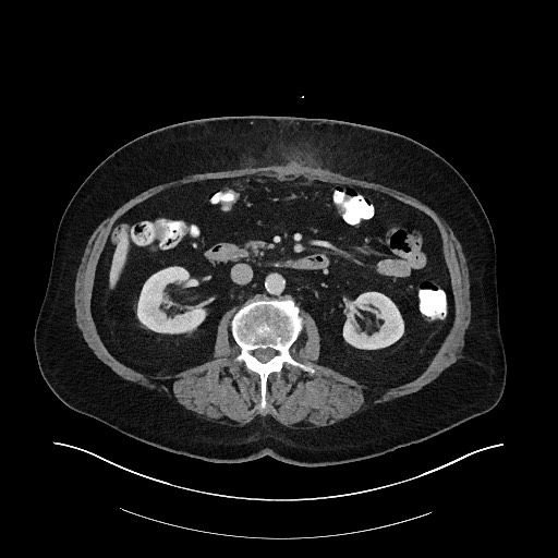 Buried bumper syndrome - gastrostomy tube (Radiopaedia 63843-72575 A 35).jpg