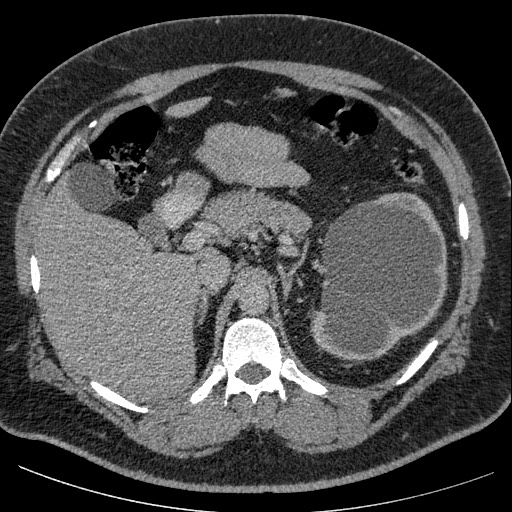Burned-out testicular seminoma - retroperitoneal nodal metastases (Radiopaedia 62872-71245 A 21).jpg