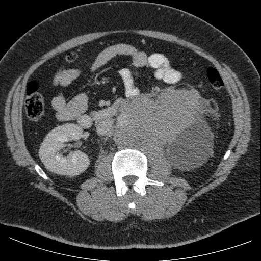 Burned-out testicular seminoma - retroperitoneal nodal metastases (Radiopaedia 62872-71245 A 34).jpg