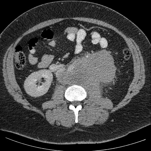 Burned-out testicular seminoma - retroperitoneal nodal metastases (Radiopaedia 62872-71245 A 37).jpg