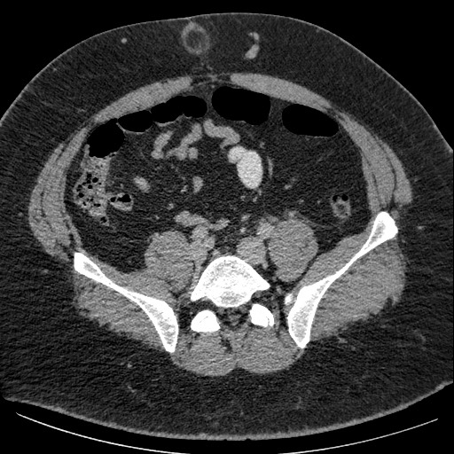 Burned-out testicular seminoma - retroperitoneal nodal metastases (Radiopaedia 62872-71245 A 52).jpg
