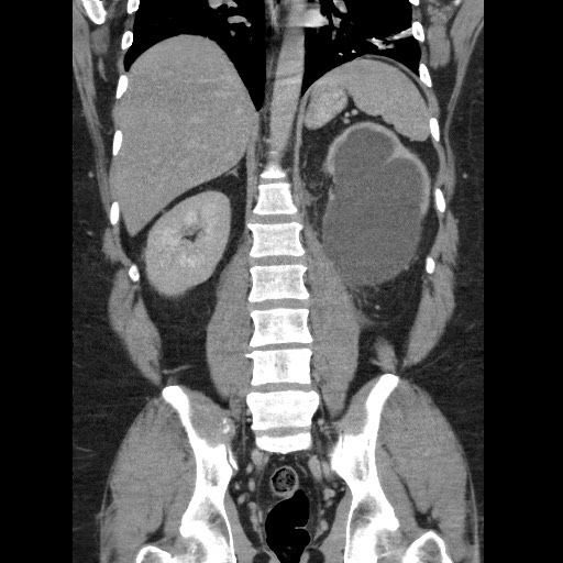 Burned-out testicular seminoma - retroperitoneal nodal metastases (Radiopaedia 62872-71245 B 45).jpg