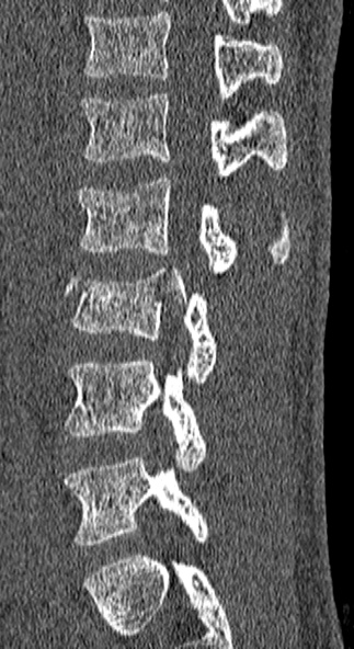 File:Burst fracture (Radiopaedia 53373-59357 Sagittal bone window 25).jpg