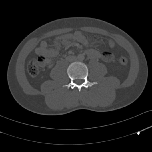 Burst fracture with cauda equina syndrome (Radiopaedia 25701-25867 Axial bone window 97).jpg