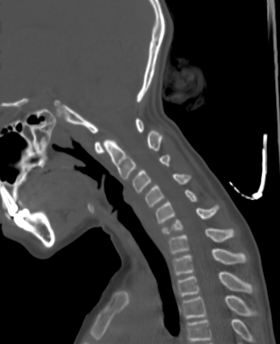 Butterfly vertebra (Radiopaedia 77903-90209 Sagittal bone window 51).jpg