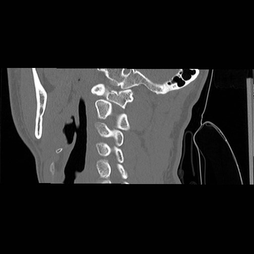 File:C1-C2 "subluxation" - normal cervical anatomy at maximum head rotation (Radiopaedia 42483-45607 C 43).jpg