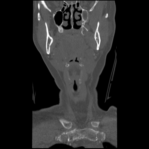 C1 anterior arch (plough) fracture - type 1 (Radiopaedia 76181-87720 Coronal bone window 86).jpg