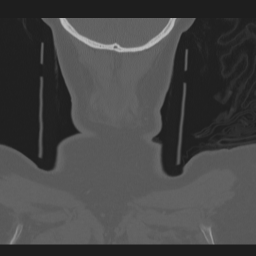C2 fracture (Radiopaedia 34091-35341 Coronal bone window 65).png