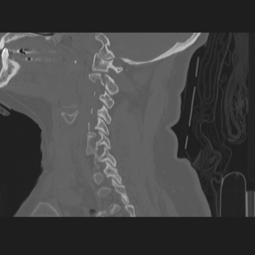 File:C2 fracture (Radiopaedia 34091-35341 Sagittal bone window 48).png