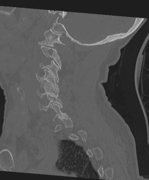 C2 fracture with vertebral artery dissection (Radiopaedia 37378-39199 Sagittal bone window 25).png