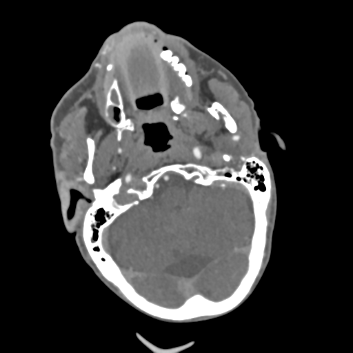 C2 fracture with vertebral artery dissection (Radiopaedia 37378-39200 A 195).png