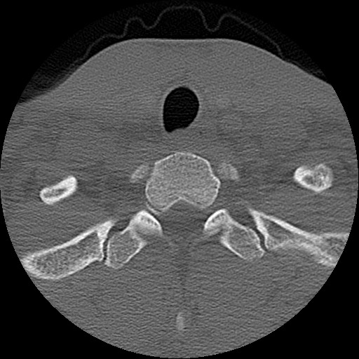 File:C5 facet fracture (Radiopaedia 58374-65499 Axial bone window 85).jpg