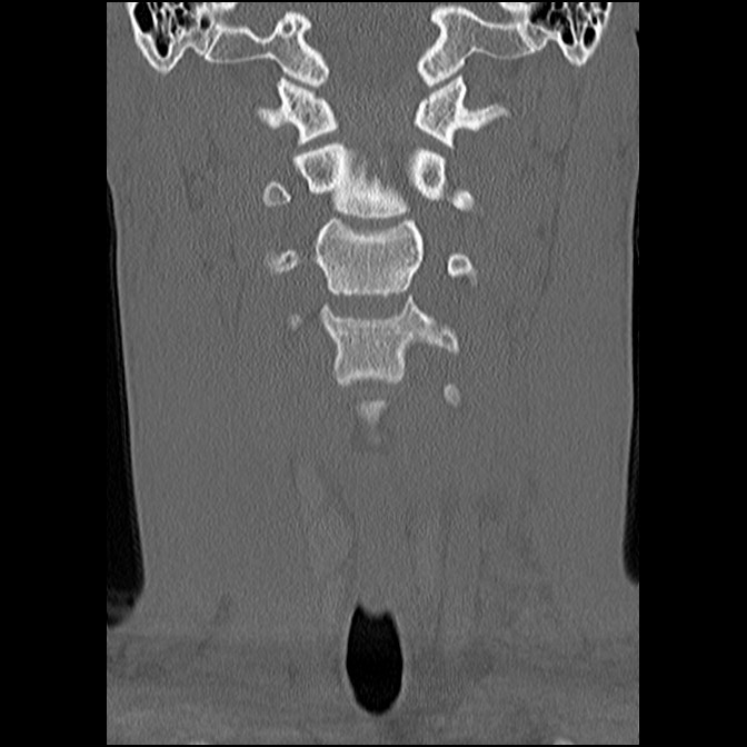 C5 facet fracture (Radiopaedia 58374-65499 Coronal bone window 24).jpg
