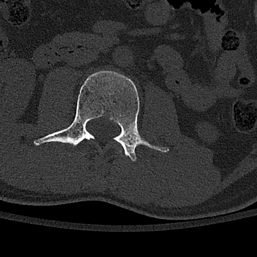 Calcaneal fractures with associated L2 burst fracture (Radiopaedia 71671-82493 Axial bone window 71).jpg