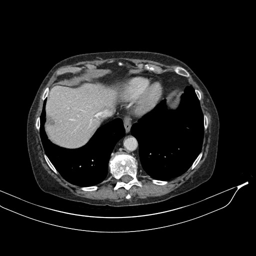 Calcified adrenal glands and Spigelian hernia (Radiopaedia 49741-54988 A 24).jpg