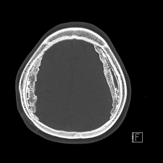 Calcified chronic subdural hematoma (Radiopaedia 77374-89492 Axial bone window 109).jpg