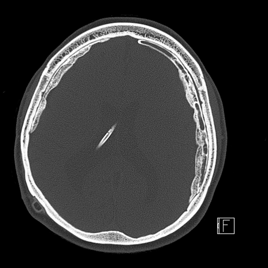 Calcified chronic subdural hematoma (Radiopaedia 77374-89492 Axial bone window 81).jpg
