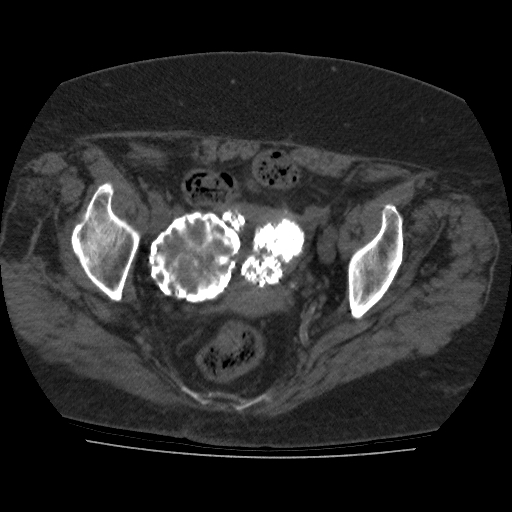 File:Calcified fibroids (Radiopaedia 16853-16579 non-contrast 8).jpg