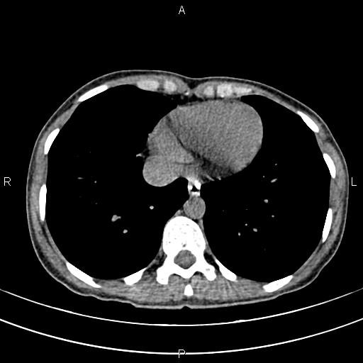 File:Calcified hepatic hydatid cyst (Radiopaedia 83870-99072 Axial non-contrast 5).jpg