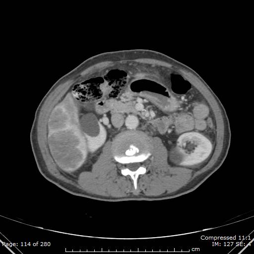 Calcified liver metastases (Radiopaedia 44699-48470 B 41).jpg