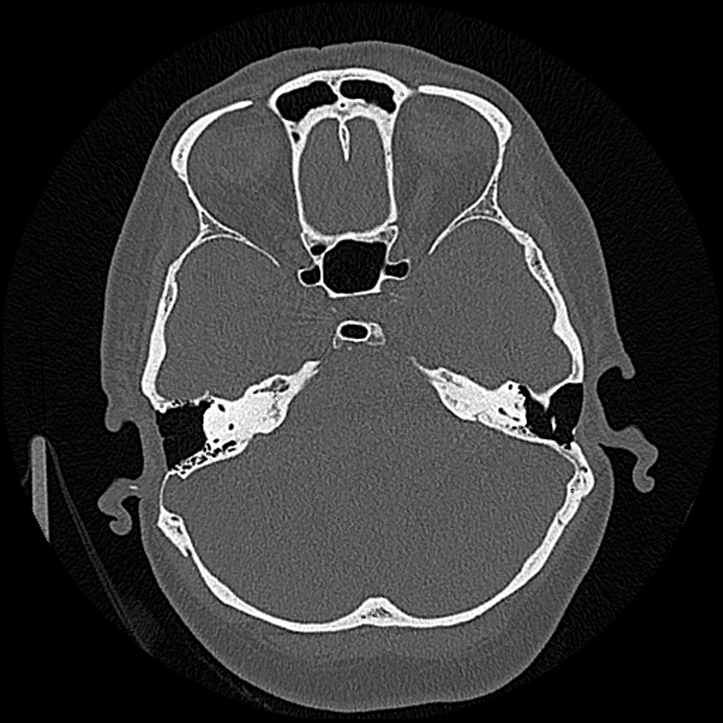 Canal up mastoidectomy (Radiopaedia 78108-90638 Axial bone window 92).jpg