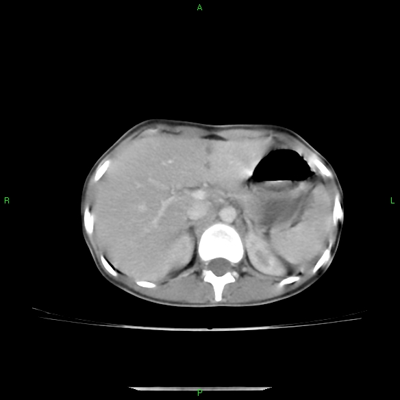 File:Cannon ball metastases - synovial sarcoma (Radiopaedia 26135-26271 C 37).jpg