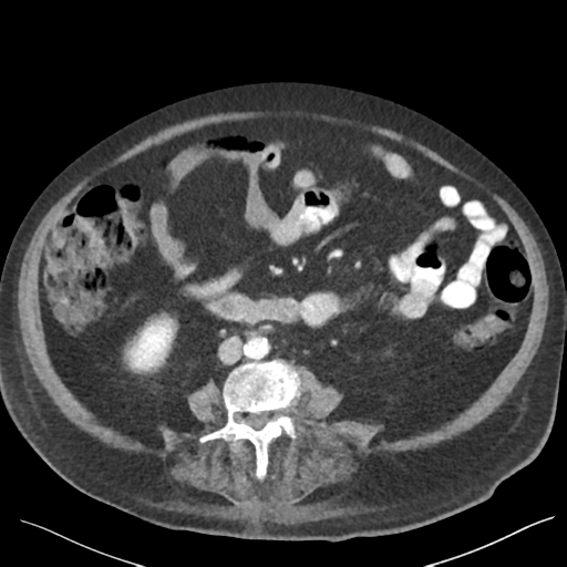 Cannonball metastases from endometrial cancer (Radiopaedia 42003-45031 E 43).png