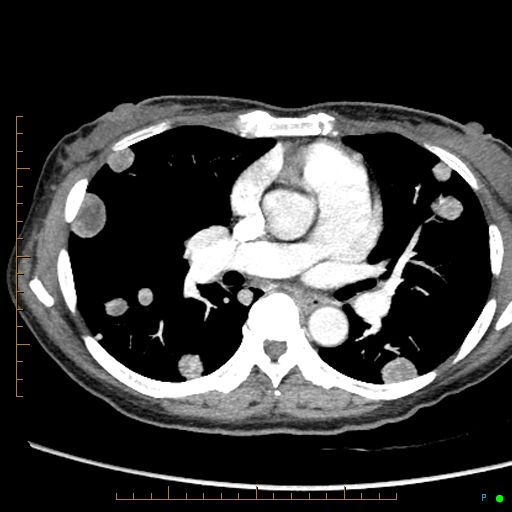 Canonball lung metastasis (Radiopaedia 77634-89837 B 46).jpg