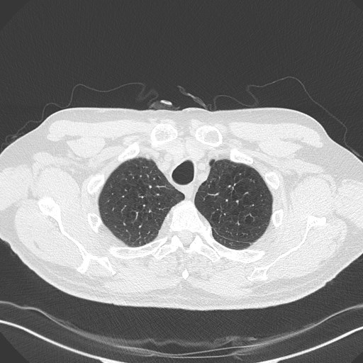 Caplan syndrome (Radiopaedia 56667-63530 Axial lung window 36).jpg
