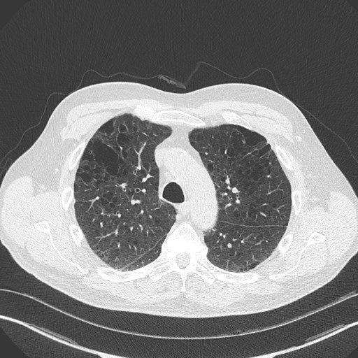 Caplan syndrome (Radiopaedia 56667-63530 Axial lung window 67).jpg