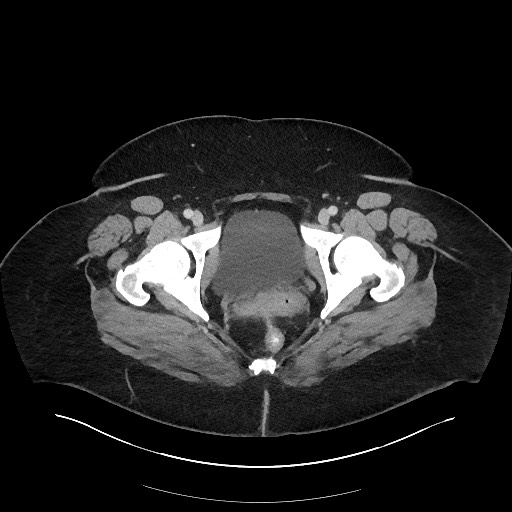 Carcinoid tumor - terminal ileum (Radiopaedia 60931-68739 A 131).jpg