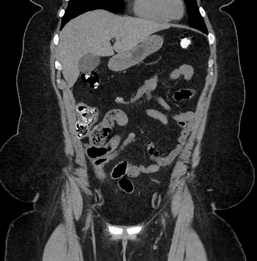 Carcinoid tumor - terminal ileum (Radiopaedia 60931-68740 Coronal non-contrast 27).jpg