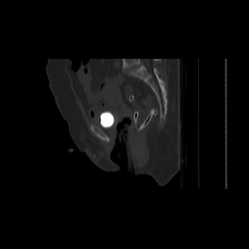 Carcinoma cervix- brachytherapy applicator (Radiopaedia 33135-34173 Sagittal bone window 98).jpg