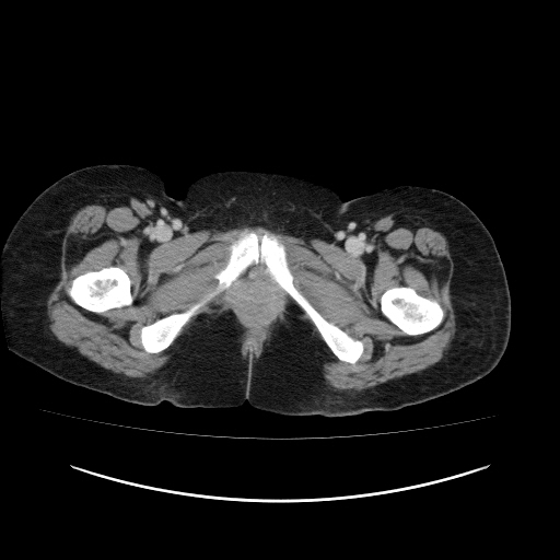 Carcinoma colon - hepatic flexure (Radiopaedia 19461-19493 A 135).jpg