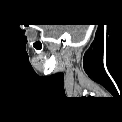 Carcinoma of the maxillary antrum (Radiopaedia 53805-59888 Sagittal C+ delayed 136).jpg