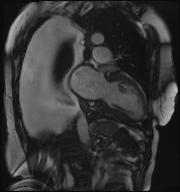 File:Cardiac amyloidosis (Radiopaedia 51404-57150 B 19).jpg