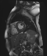 Cardiac amyloidosis (Radiopaedia 51404-57150 Sagittal CINE SSFP 173).jpg