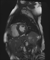 Cardiac amyloidosis (Radiopaedia 51404-57150 Sagittal CINE SSFP 194).jpg