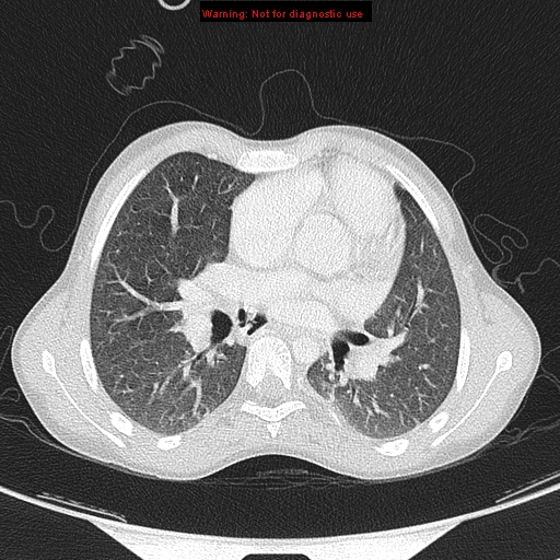 File:Cardiac bronchus (Radiopaedia 14059-13899 A 22).jpg