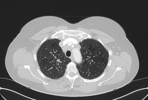 Cardiac sarcoidosis (Radiopaedia 74548-85534 Axial lung window 20).jpg