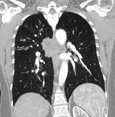 File:Cardiac sarcoidosis (Radiopaedia 74548-85534 Coronal lung window 43).jpg