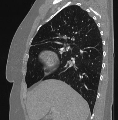 File:Cardiac sarcoidosis (Radiopaedia 74548-85534 Sagittal lung window 65).jpg