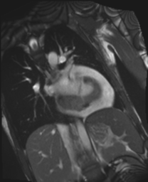 File:Cardiac tumor - undifferentiated pleomorphic sarcoma (Radiopaedia 45844-50136 Oblique T2 3).png